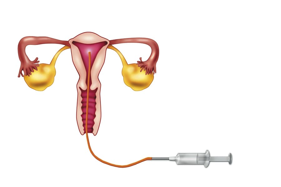 IUI vergoeding