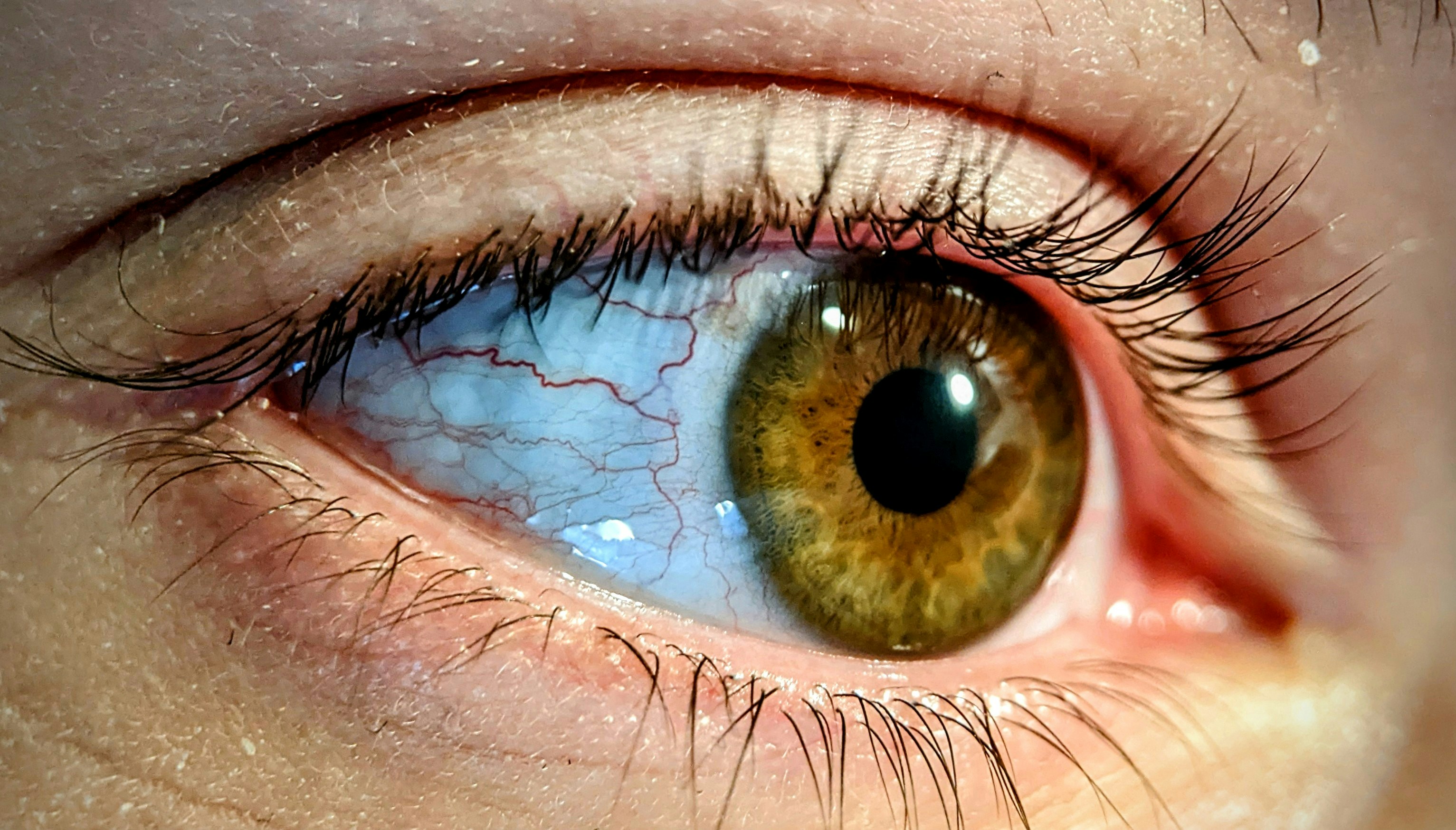 vergoeding emdr therapie 2026