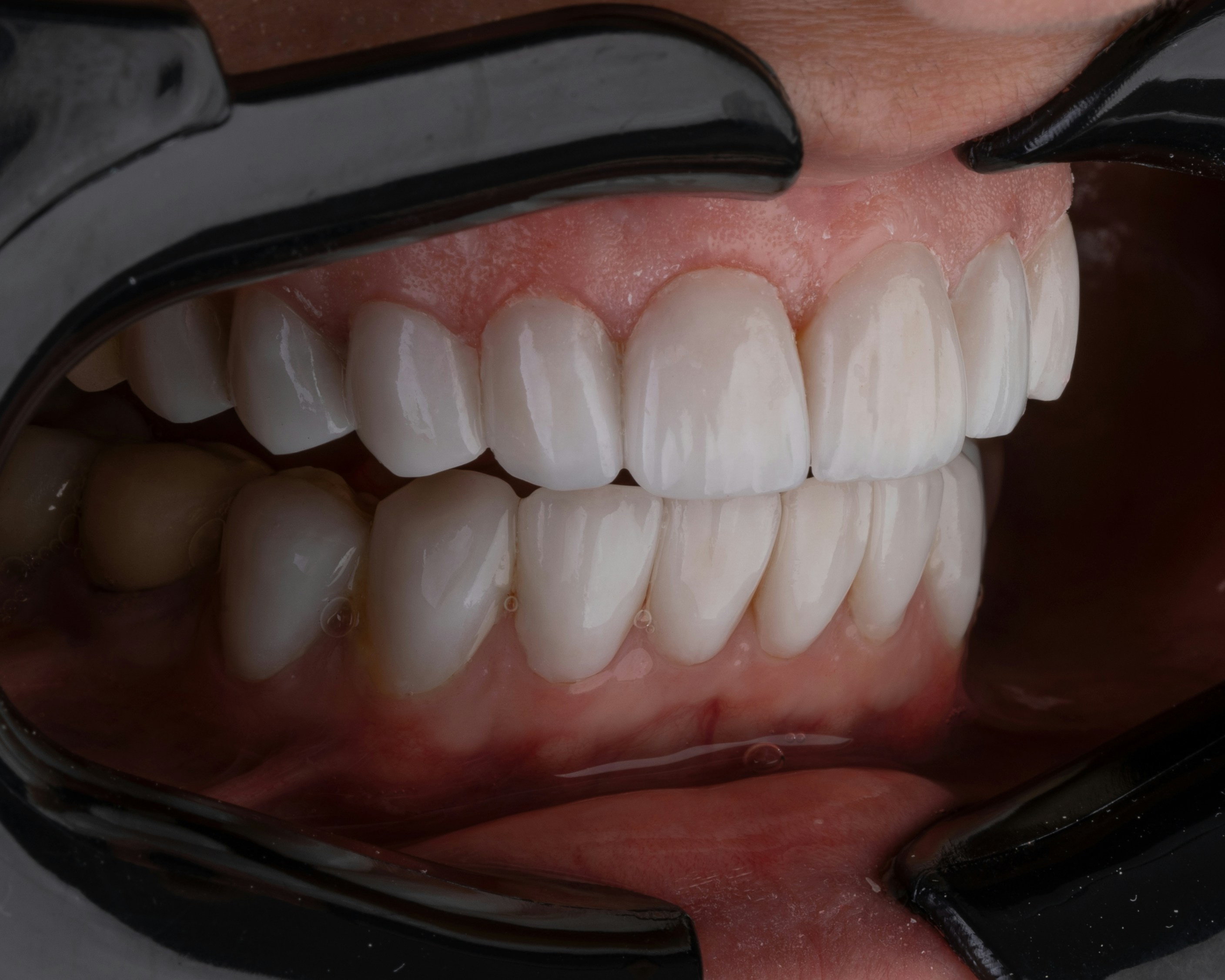 vergoeding klikgebit