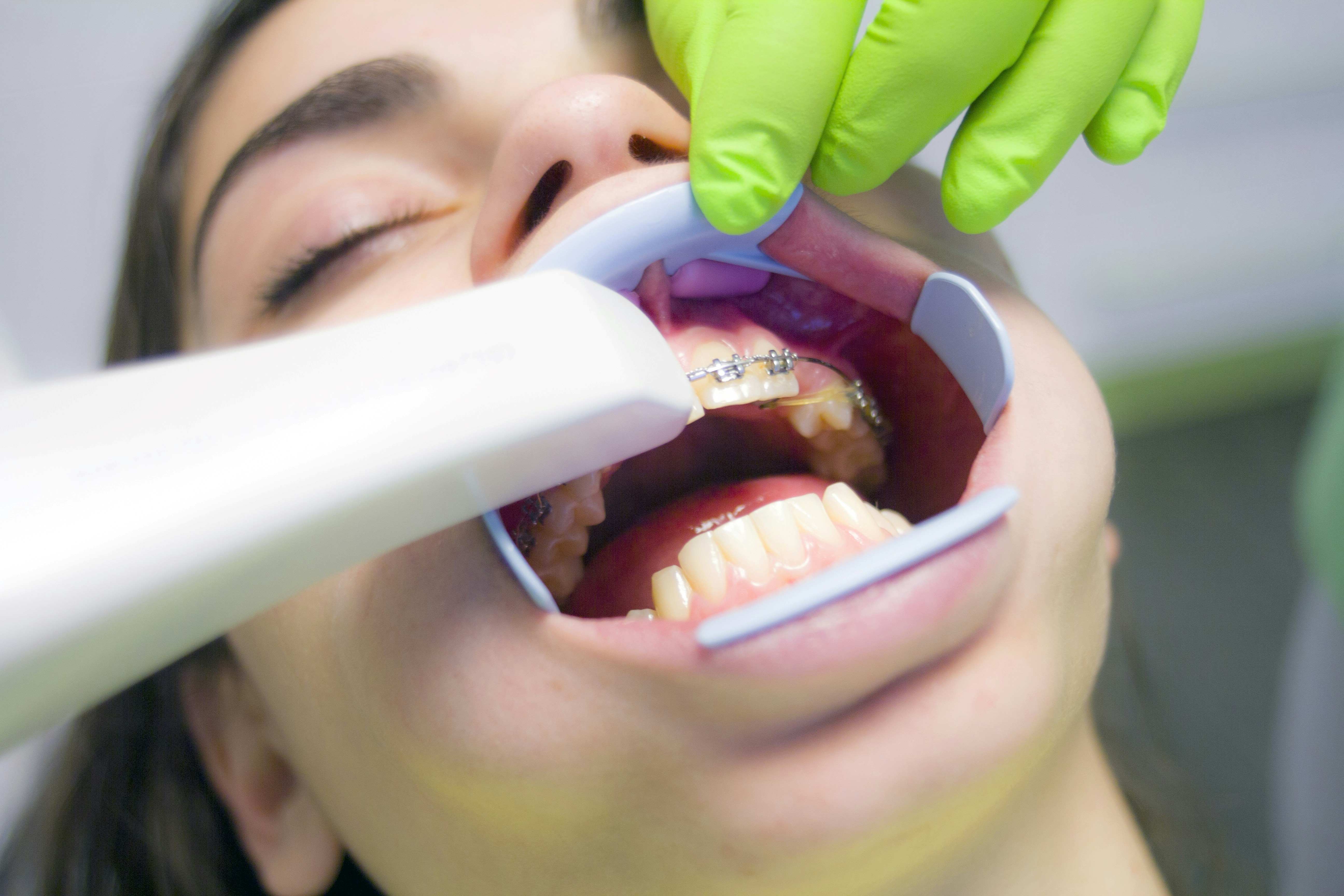 vergoeding orthodontie zonder wachttijd